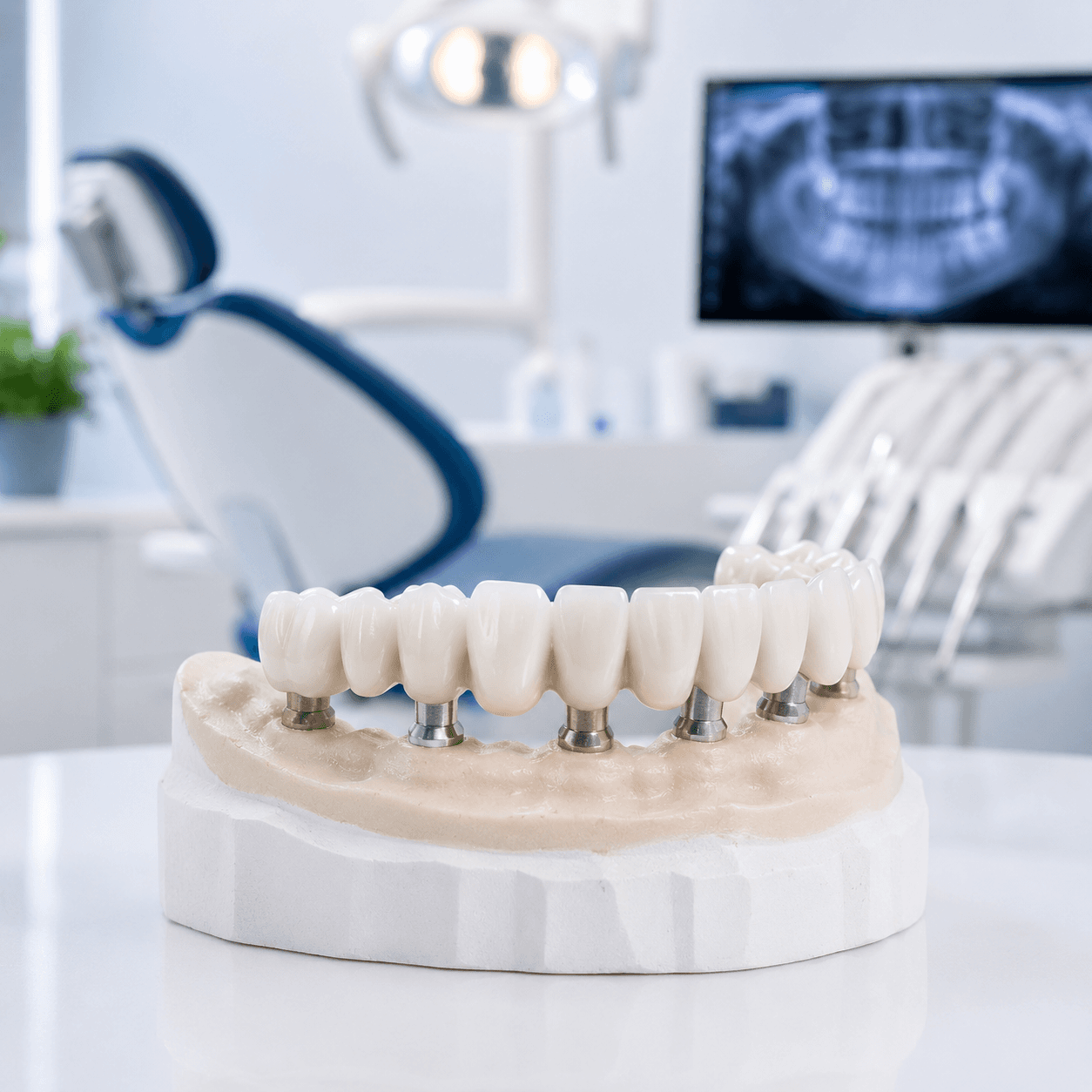 Full-Mouth Rehabilitation with Implants
